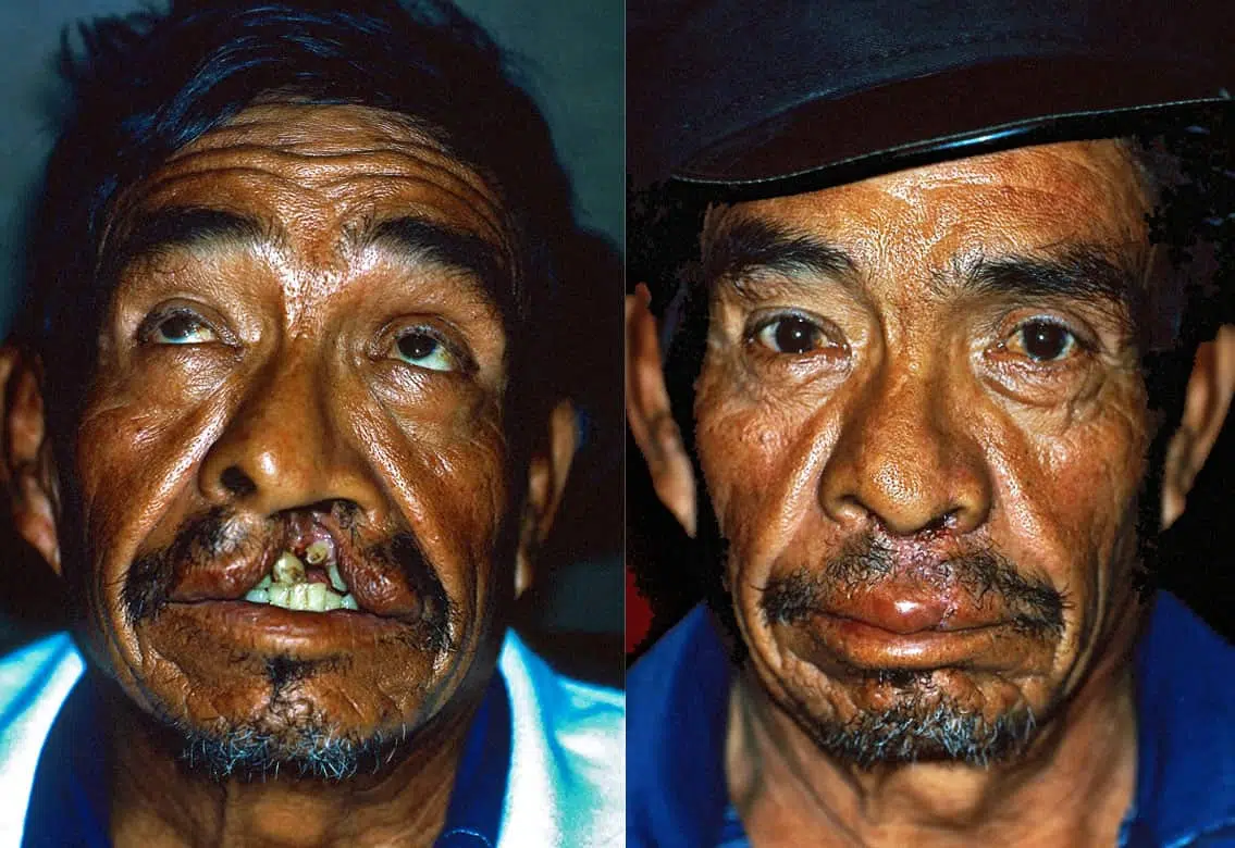 1987 · A life changed. Another inspired. 
Rafael's surgery transformed his life and helped inspire a volunteer's 40 years of service.