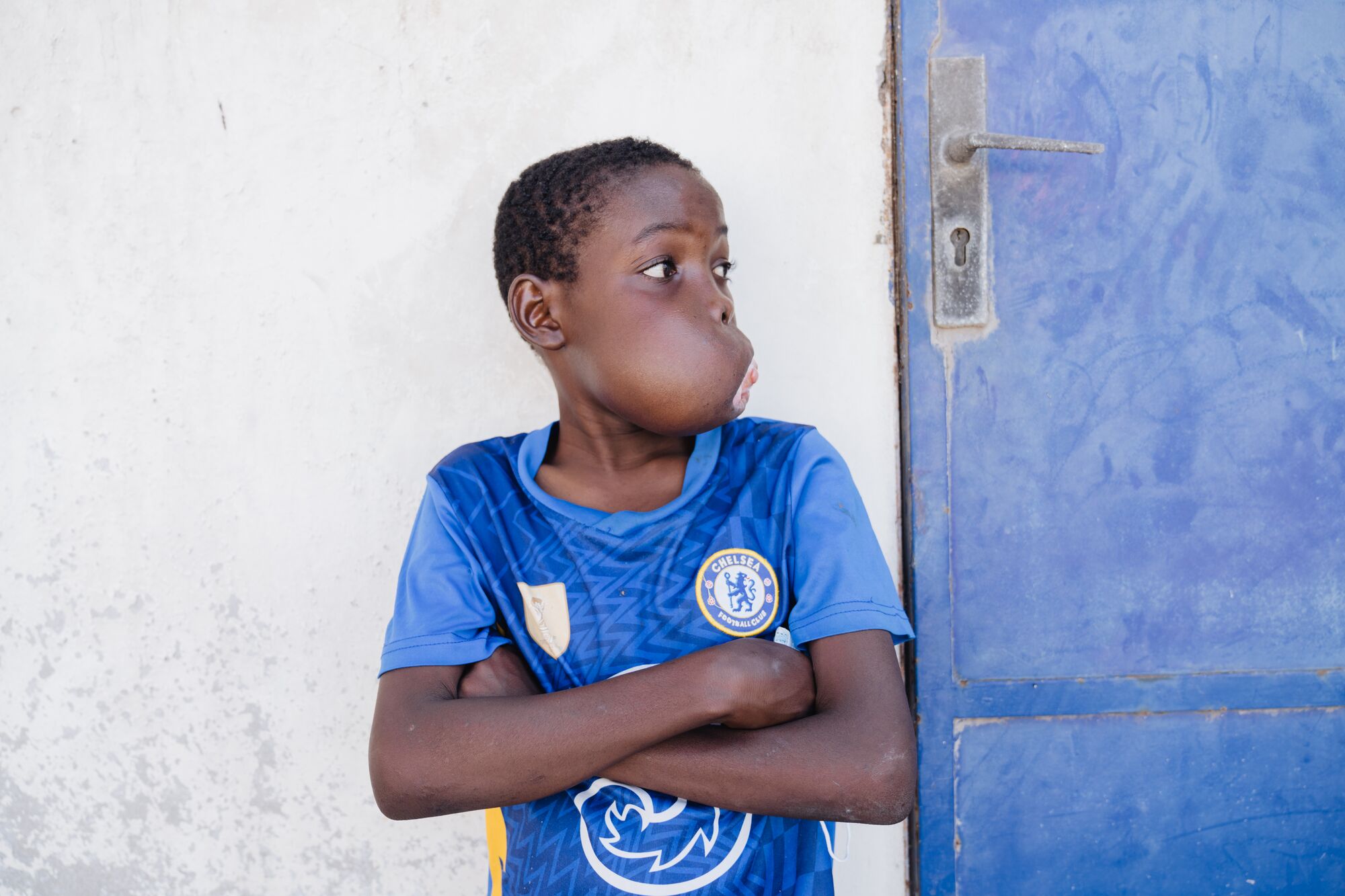 What began as a small growth when Daouda was a toddler eventually made eating and speaking difficult.