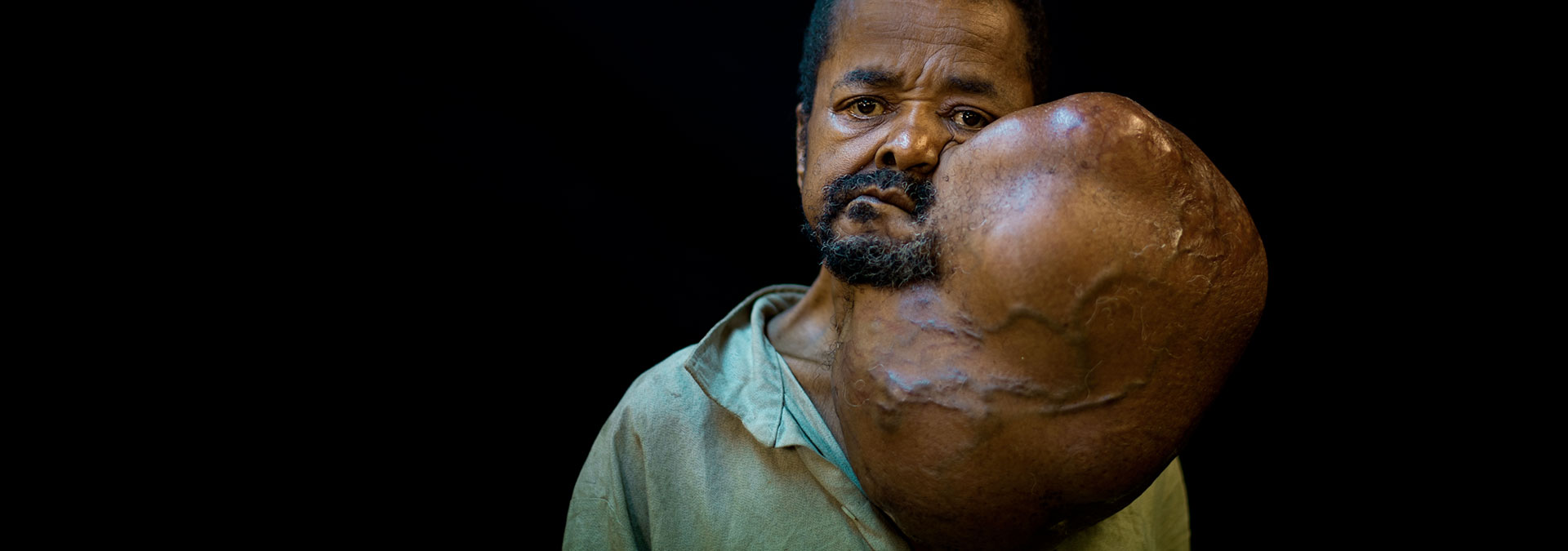 2014/15
Sambany, Madagascar
2015 · A 36-year burden lifted
After an extraordinary journey to reach the ship, Sambany returned home free from the tumour that had shaped much of his life.
