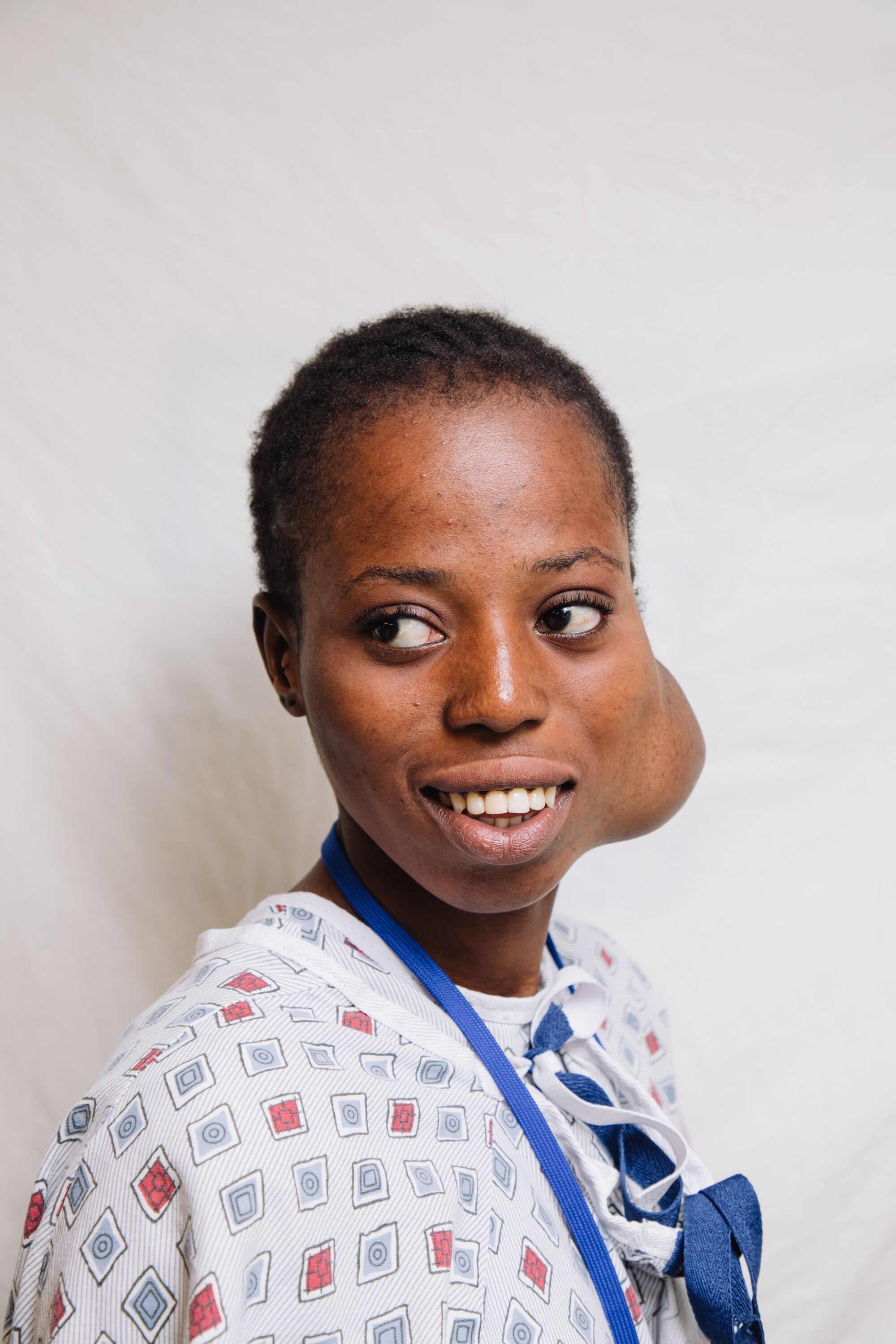 The swelling in Khoudia's cheek first appeared when she was 10. Over the next eight years, the tumor continued to grow as her family searched for treatment.